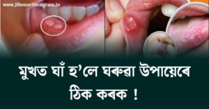 Treat mouth ulcers with home remedies